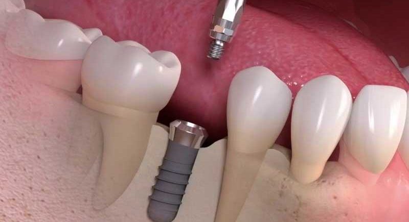 Implantes dentários: 10 mitos e verdades.